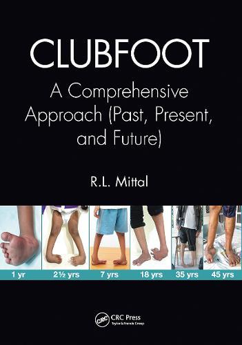 Clubfoot: A Comprehensive Approach (Past, Present, and Future)