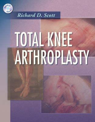Total Knee Arthroplasty