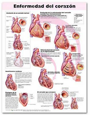 Heart Disease Anatomical Chart in Spanish (Enfermedad Del Corazon)