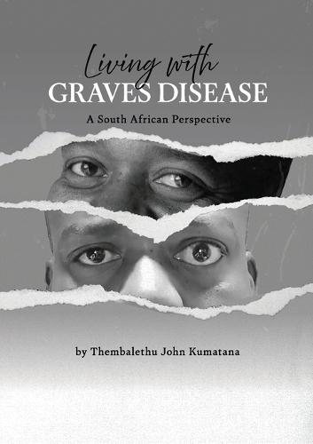 Living with Graves Disease: A South African Perspective