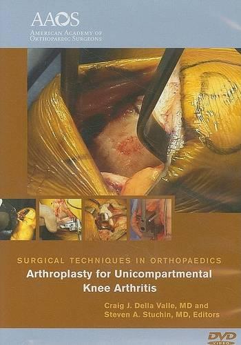 Arthroplasty for Unicompartmental Knee Arthritis