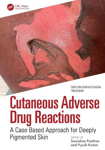 Cutaneous Adverse Drug Reactions: A Case Based Approach for Deeply Pigmented Skin