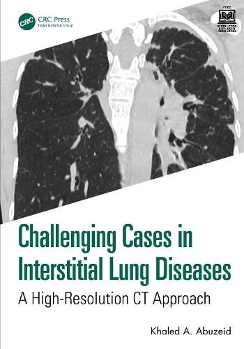 Challenging Cases in Interstitial Lung Diseases: A High-Resolution CT Approach