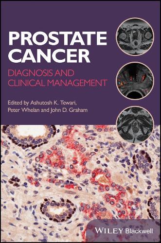 Prostate Cancer: Diagnosis and Clinical Management