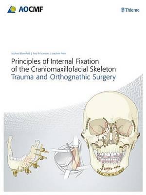 Principles of Internal Fixation of the Craniomaxillofacial Skeleton