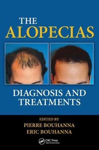The Alopecias: Diagnosis and Treatments