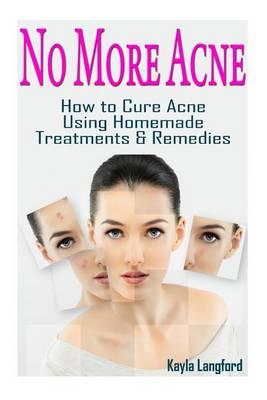 No More Acne: How to Cure Acne Using Homemade Treatments & Remedies