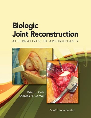 Biologic Joint Reconstruction: Alternatives to Joint Arthroplasty