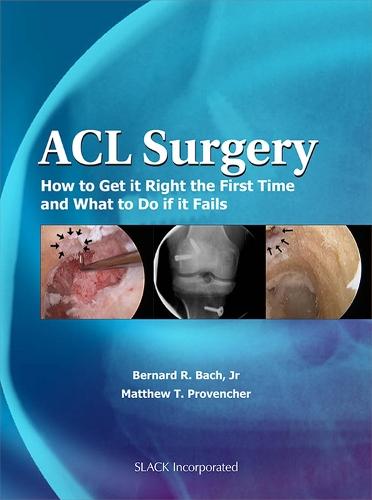 ACL Surgery: How to Get it Right the First Time and What to Do When Your Surgery Fails