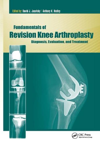 Fundamentals of Revision Knee Arthroplasty: Diagnosis, Evaluation, and Treatment