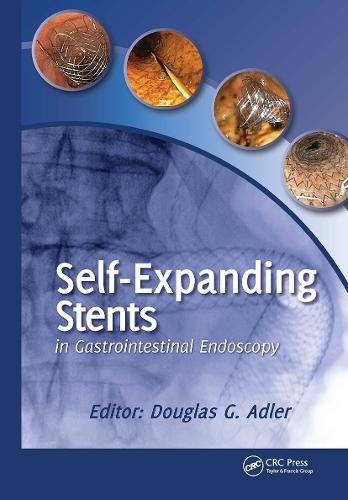 Self-Expanding Stents in Gastrointestinal Endoscopy