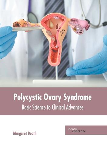 Polycystic Ovary Syndrome: Basic Science to Clinical Advances