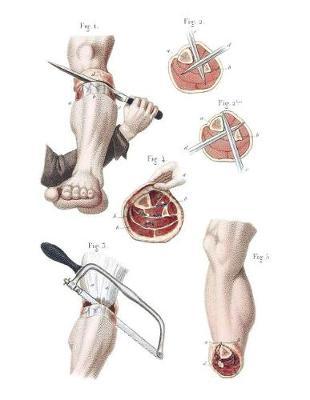 Amputation of the Leg Notebook: 8-1/2x11 One Subject College Ruled Lined Paper 70 Sheets/140 Pages in White - Great for Class Especially Medical, Biology, & Life Science Lab, Lecture, & Residency Notes