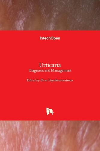 Urticaria: Diagnosis and Management