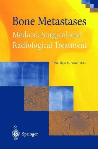 Bone Metastases: Medical, Surgical and Radiological Treatment