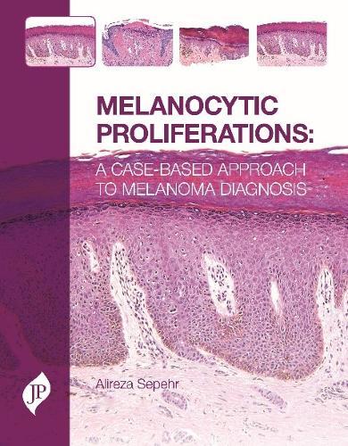 Melanocytic Proliferations: A Case-Based Approach to Melanoma Diagnosis