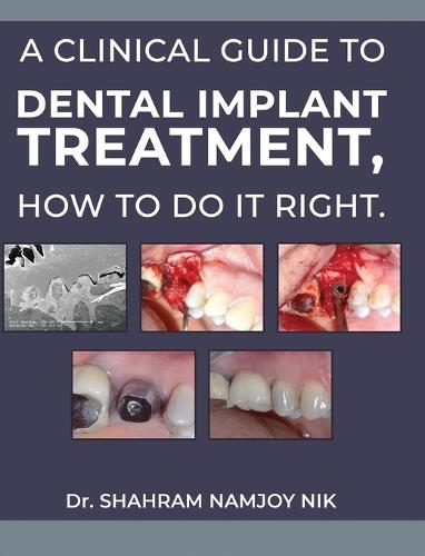 A guide to dental implant treatment, how to do it right.