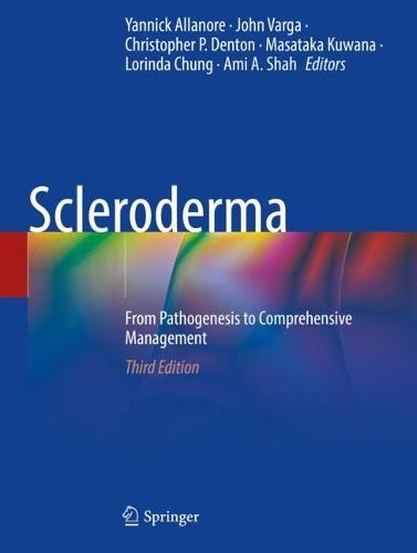 Scleroderma: From Pathogenesis to Comprehensive Management