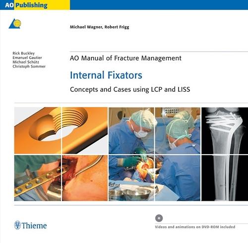 AO Manual of Fracture Management: Internal Fixators: Concepts and Cases Using LCP/LISS