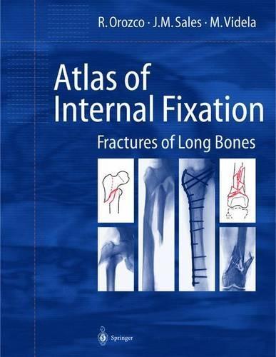Atlas of Internal Fixation: Fracture of Long Bones : Classification, Statistical Analysis, Technique, Radiology
