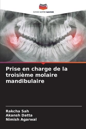 Prise en charge de la troisième molaire mandibulaire