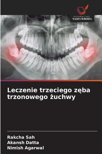 Leczenie trzeciego zęba trzonowego żuchwy