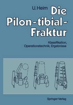 Die Pilon-tibial-Fraktur: Klassifikation, Operationstechnik, Ergebnisse