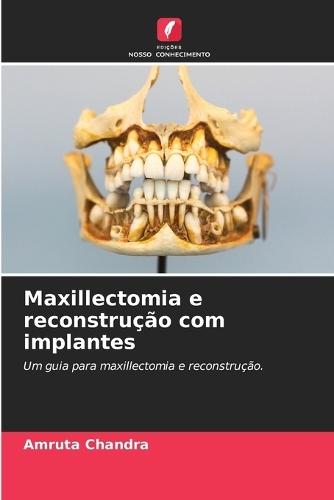 Maxillectomia e reconstrução com implantes