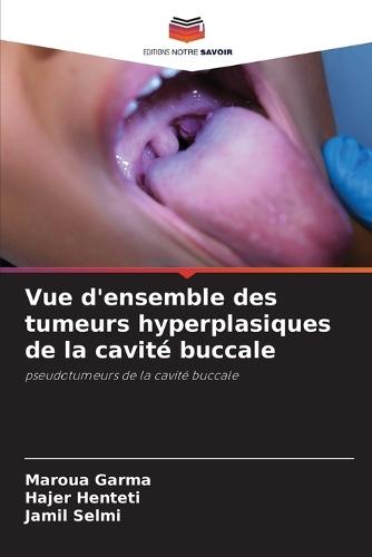 Vue d'ensemble des tumeurs hyperplasiques de la cavité buccale