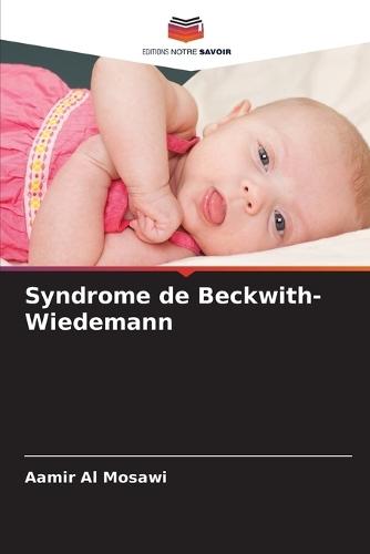 Syndrome de Beckwith-Wiedemann