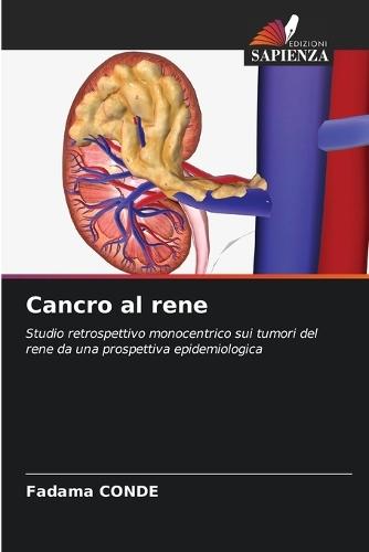 Cancro al rene