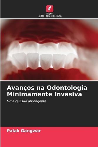 Avanços na Odontologia Minimamente Invasiva