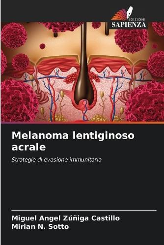 Melanoma lentiginoso acrale