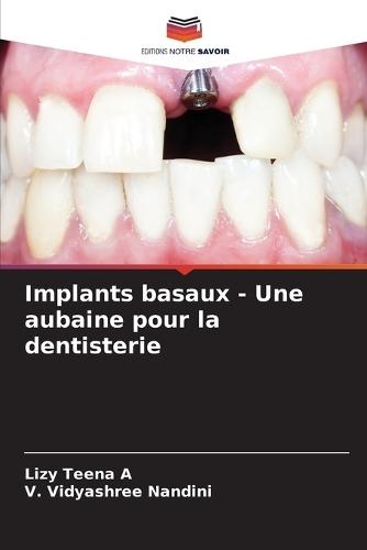 Implants basaux - Une aubaine pour la dentisterie