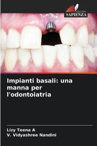 Impianti basali: una manna per l'odontoiatria