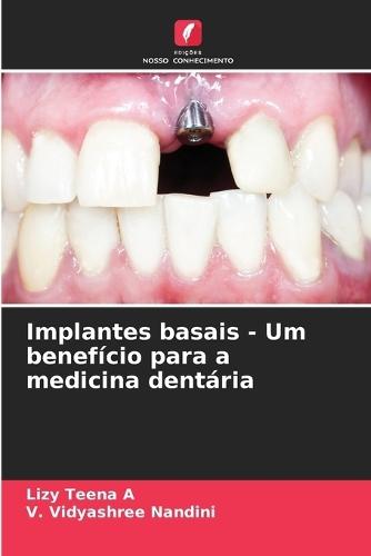 Implantes basais - Um benefício para a medicina dentária
