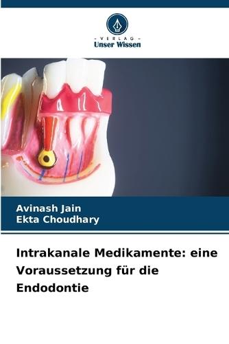 Intrakanale Medikamente: eine Voraussetzung für die Endodontie