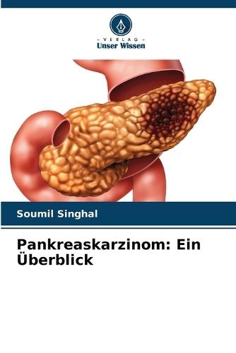 Pankreaskarzinom: Ein Überblick