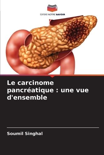 Le carcinome pancréatique: une vue d'ensemble
