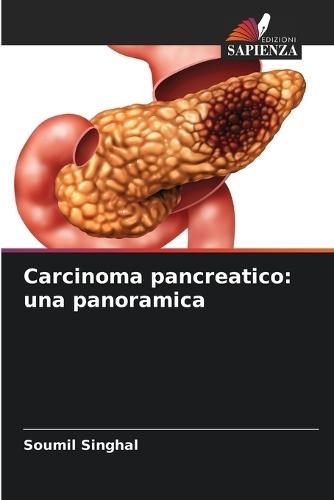 Carcinoma pancreatico: una panoramica