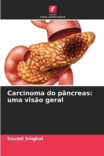 Carcinoma do pâncreas: uma visão geral
