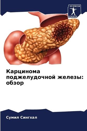 Карцинома поджелудочной железы: обзор