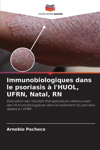 Immunobiologiques dans le psoriasis à l'HUOL, UFRN, Natal, RN