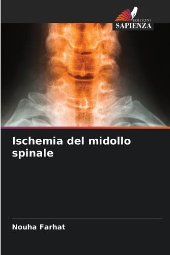 Ischemia del midollo spinale