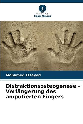 Distraktionsosteogenese - Verlängerung des amputierten Fingers