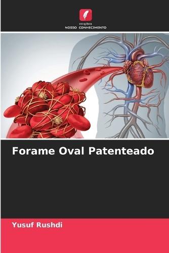 Forame Oval Patenteado
