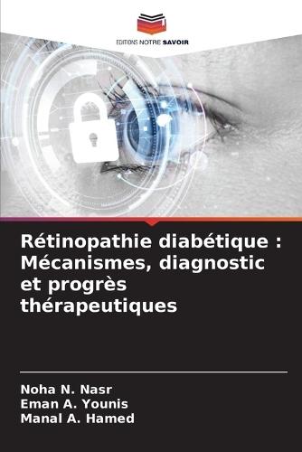 Rétinopathie diabétique: Mécanismes, diagnostic et progrès thérapeutiques