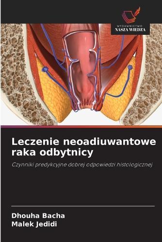 Leczenie neoadiuwantowe raka odbytnicy