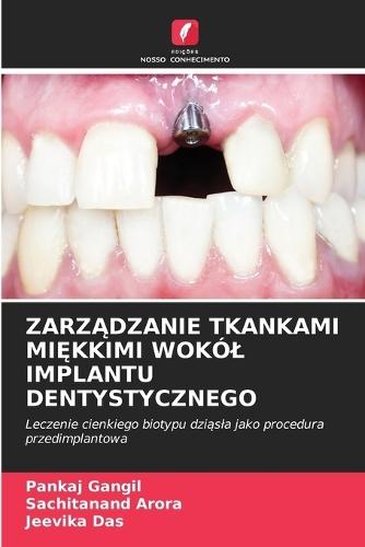 Zarz&#260;dzanie Tkankami Mi&#280;kkimi Wokól Implantu Dentystycznego