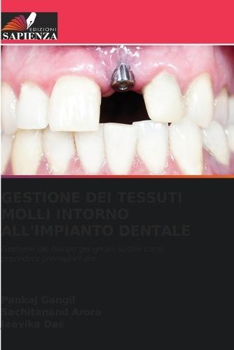 Gestione Dei Tessuti Molli Intorno All'impianto Dentale